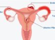 Female infertility symptoms