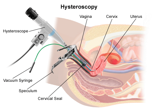 Hysteroscopy Biopsy
