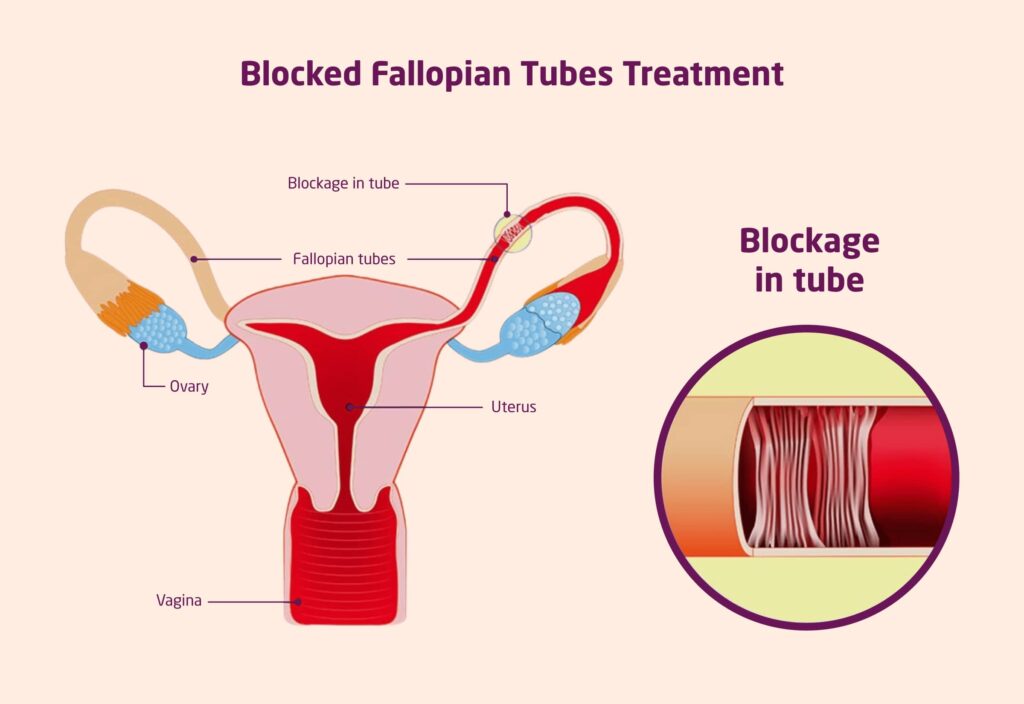 blocked fallopian tube parts