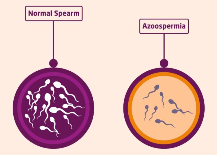 how common is man infertility
