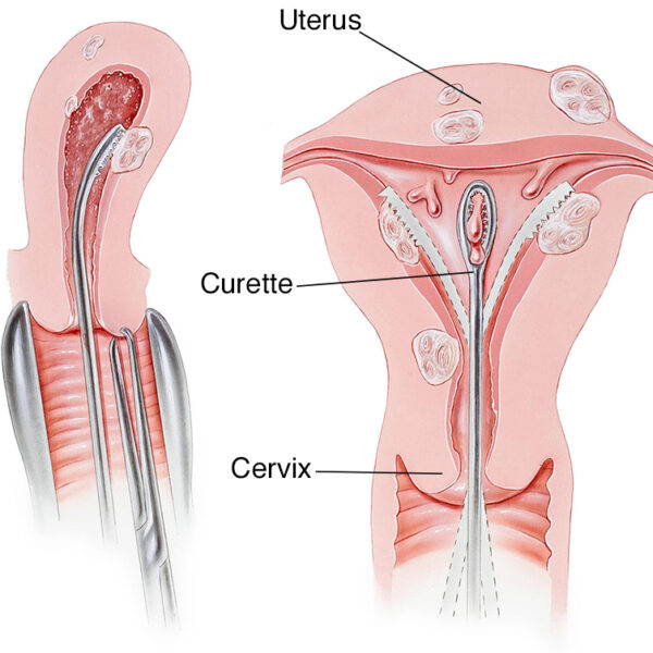 how long does a hysteroscopy takes