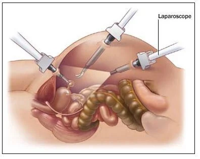 laparoscopy recovery times